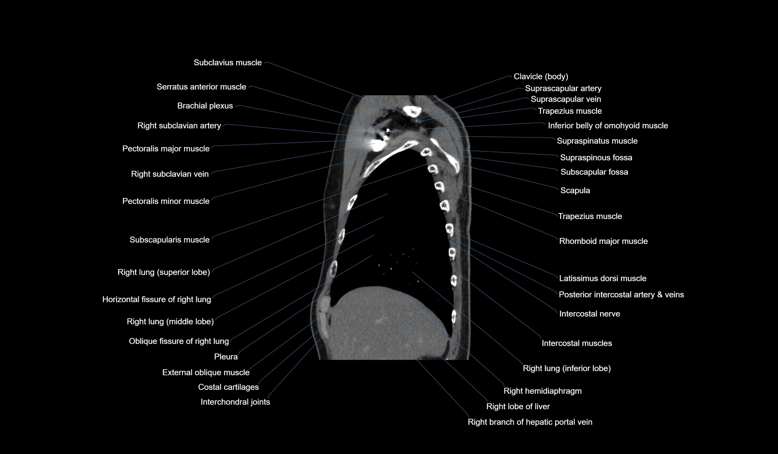 CT chest (thorax) soft tissue window labelled sagittal cross sectional anatomy radiology image-00031.webp